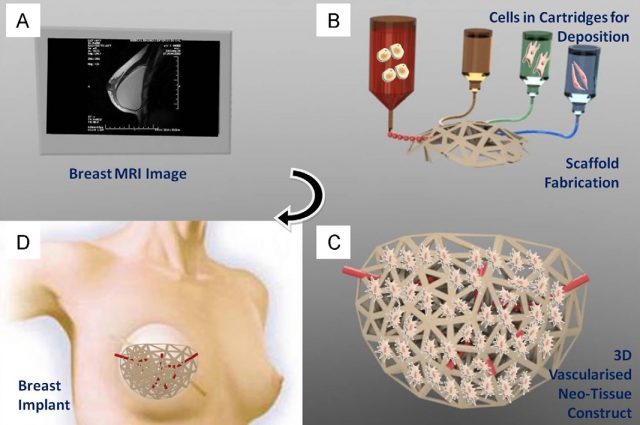 Figure 1. AM technologies allow the production of personalized implants. A: Breast image captured by magnetic resonance imaging. B: Additive manufacturing of scaffolding structure together with cells suspended in gels. C: 3D vascularized implant. D: Breast implantation after mastectomy. | Credit: Melchels et al. (2012).