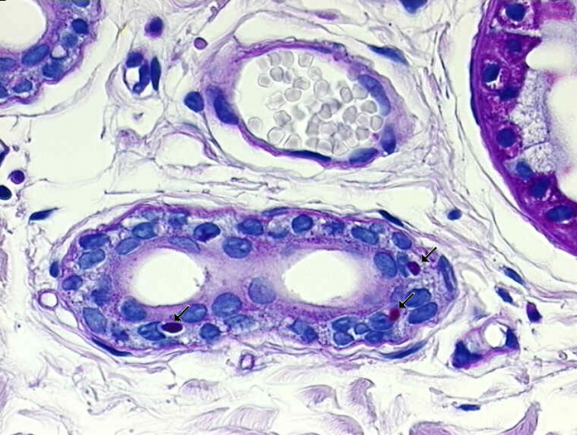 The Lone Ranger? No, a skin biopsy showing sweat glands of a Lafora disease patient. The tissue is stained with a substance that reacts with polysaccharides, in order to detect the aberrant granules called Lafora bodies (arrows). | Credit: Dermatopathologie Friedrichshafen