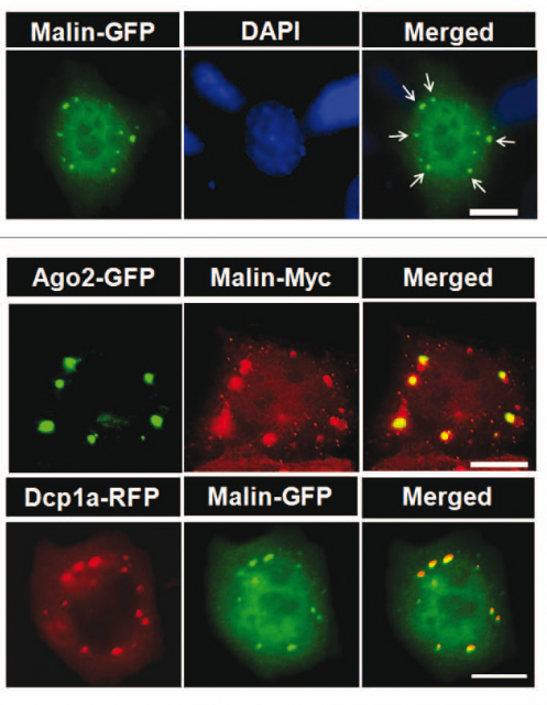 Figure 3. Cells containing a modified malin bound to a green fluorescent protein (GFP) shows tha the protein distributes in granules surrounding the cell nucleus (stained with DAPI, in blue). Combining different versions of malin and proteins characteristic of processing bodies, with different colors (RFP, red fluorescent protein) it is shown that the location of malin and those proteins in the granules are exactly coincident | Credit: Singh et al (2012)