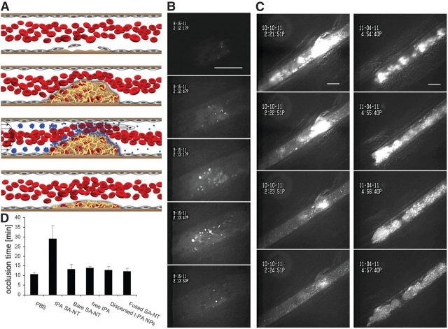 Figure 3. (A) Schematic of SA-NTs’ strategy. Ferric chloride injury initiates formation of a thrombus (top) that grows to partially obstruct blood flow (top middle). Injected SA-NTs dissociate into NPs at the thrombus (bottom middle). Accumulation of tPA-coated NPs and binding to the clot at the occlusion site progressively dissolve the obstruction (bottom). (B) Sequential intravital fluorescence microscopic images of a thrombus in a partially occluded mesenteric artery recorded over a 5-min period beginning after bolus injection of fluorescent tPA-coated SA-NTs (1 mg NPs; 50 ng tPA) 8 min after injury initiation. Scale bar, 100 μm. The NPs accumulate at the clot, first visualizing its location and then demonstrating clearance of the clot within 5 min after injection at the bottom. (C) Sequence of intravital fluorescence microscopic images recorded over a 5-min period showing fluorescently labeled platelets accumulated within a forming thrombus that partially occludes a mesenteric artery 8 min after injury. Thrombosis is then treated with injection of either tPA-carrying SA-NTs (50 ng tPA) (left) or PBS (right). Scale bar, 100 μm. The clot on the left is greatly reduced in size within 5 min after SA-NTs injection, whereas the control vessel on the right fully occludes over the same time period. (D) Graph showing occlusion time for different treatments: SA-NTs carrying 50 ng tPA (tPA-SA-NT), soluble tPA (free tPA), uncoated SA-NTs (bare SA-NT), tPA-coated NPs that were artificially dissociated from SA-NTs before injection (dispersed tPA-NPs), and heat-fused NP microaggregates with tPA coating that do not dissociate (fused SA-NT). | Credit: Korin et al. (2012)