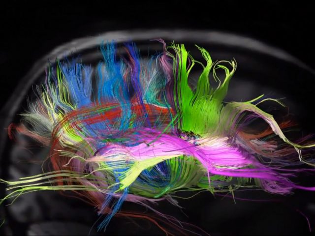 Brain scan image: BBC / Stanford University