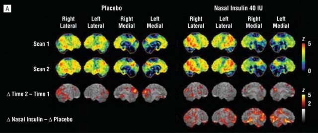 Figure 1. The figure shows examples of brain 18F-FDG scans from moderate AD patients before (scan 1) and after the intranasal administration of insulin or placebo during 4 months (scan 2). The red and orange colors, compared with the green and blue colors, indicate areas of greater hypometabolism (or brain malfunction) from time 1 to time 2. Some improvement can be observed in insulin treated patients. | Credit: Modified from Craft S et al (2012)