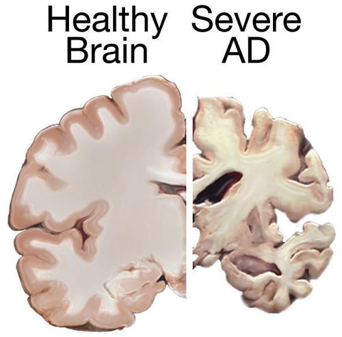 Figure 1. Two coronal brain slices can be compared (left, a healthy brain - right, a brain with severe Alzheimer's disease).