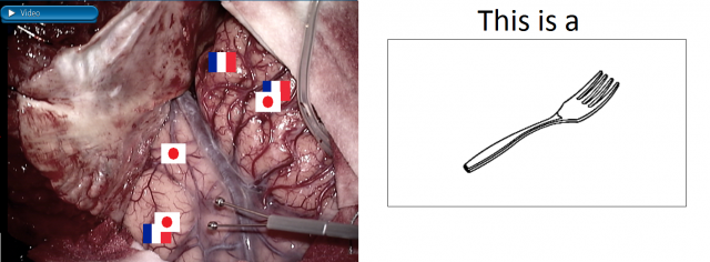 Figure 2. Example of bilingual brain surgery. Left: representation of the responses of a bilingual Japanese-French person. The electrical stimulator can be seen in the picture. Right: example of an object naming stimuli.