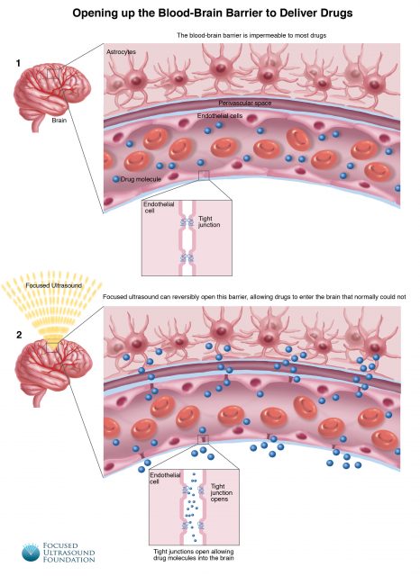 FUSF BBB illustration