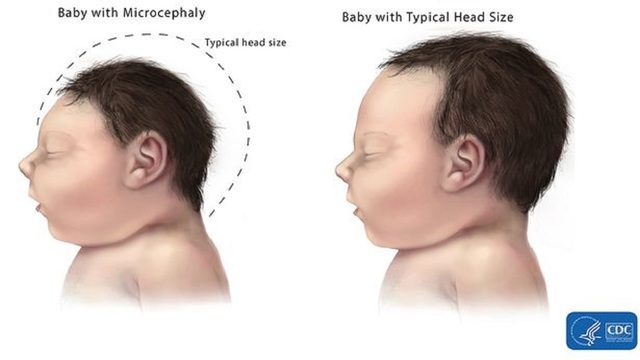 Microcephaly (Center for Disease Control)