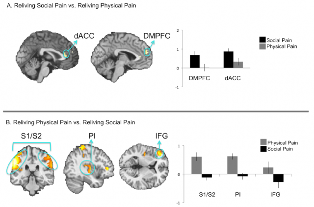 Reliving Social pain vs Physical pain. A.-Social pain activates preferentially zones part of the affective component like the anterior cingulate cortex (dACC) and the dorsal medial prefrontal cortex (DMPFC), B.- meanwhile physical pain activates preferentially zones related with the sensory component like the secondary somatosensory cortices (S1/S2), the posterior insula or the inferior frontal gyrus (IFG). Adapted from Meyer et al., 2015