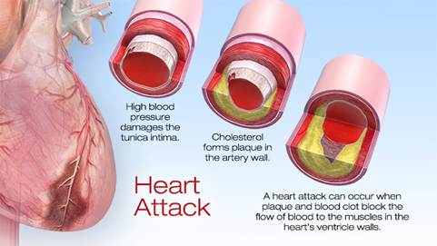 myocardial-ischemia-1