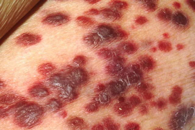 Kaposi's sarcoma