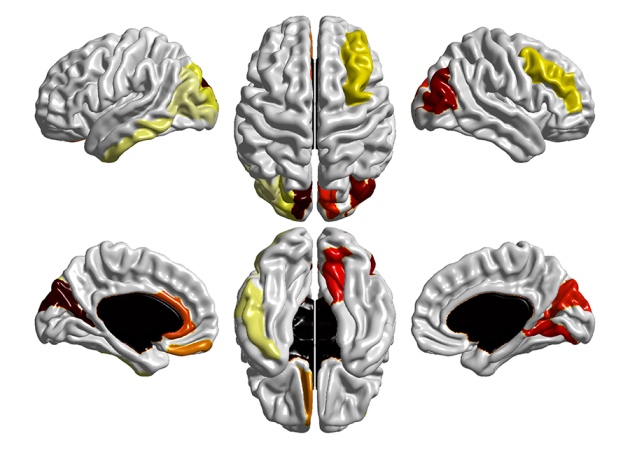 Diagnosing Autism Using Brain Scans Mapping Ignorance