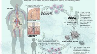 Gene therapy is back: The X-ALD case