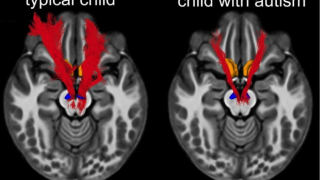 Differences in the reward pathway in autism