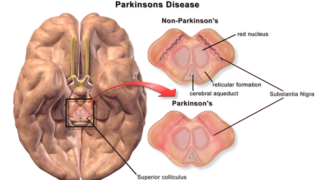How to treat Parkinson’s with astrocytes