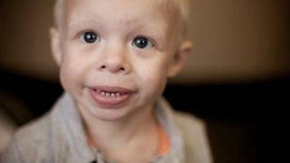 Williams syndrome and autism in the same child