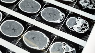 AI can predict Alzheimer’s risk from brain scans
