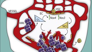 Vascular permeability in the bone marrow and drug response in Acute Myeloid Leukemia