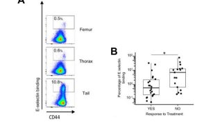 Biomarkers of chemoresistant leukemic cells in human T-ALL