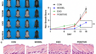 Secretome of dental pulp stem cells as a potential therapy for androgenetic alopecia